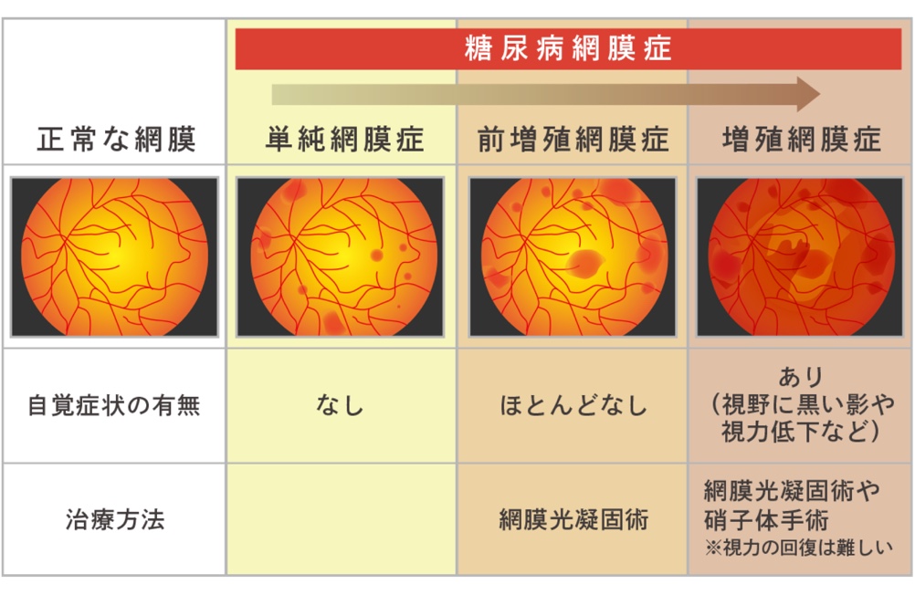 糖尿病による視力低下はどのように治療しますか?